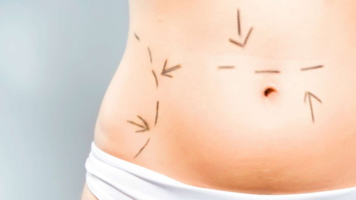Abdominoplastia / Lipectomía