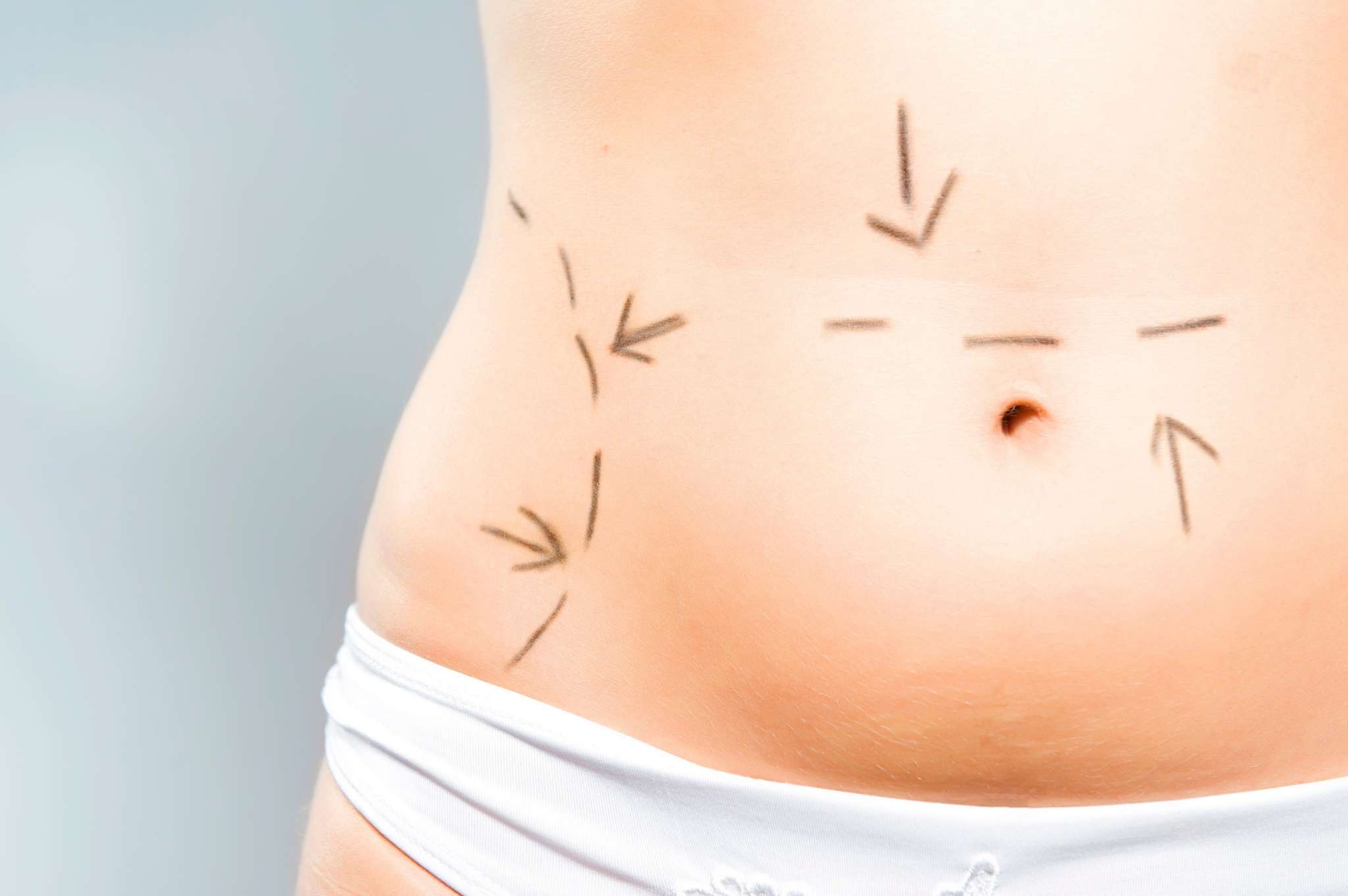Abdominoplastia / Lipectomía