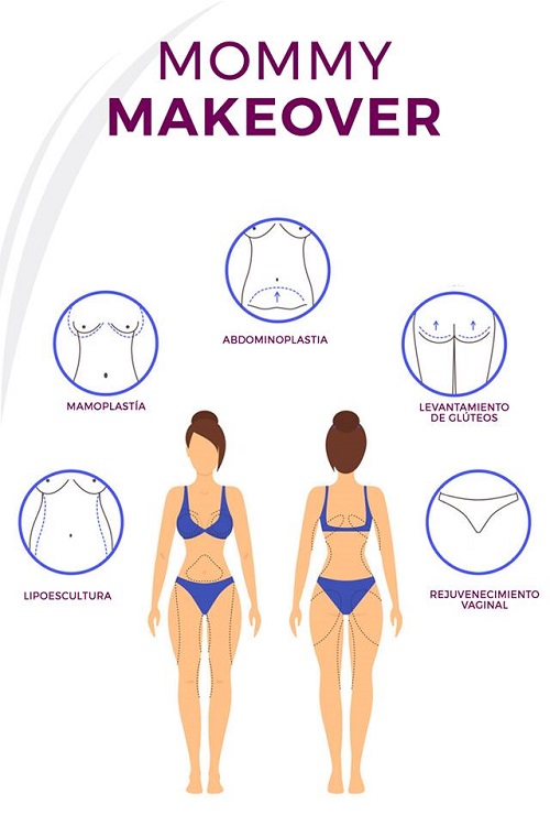 infografía mommy makeover